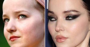 dove cameron plastic surgery 2