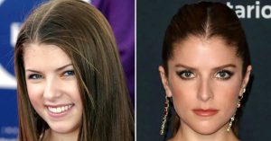 anna kendrick plastic surgery