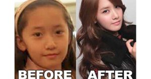 yoona plastic surgery