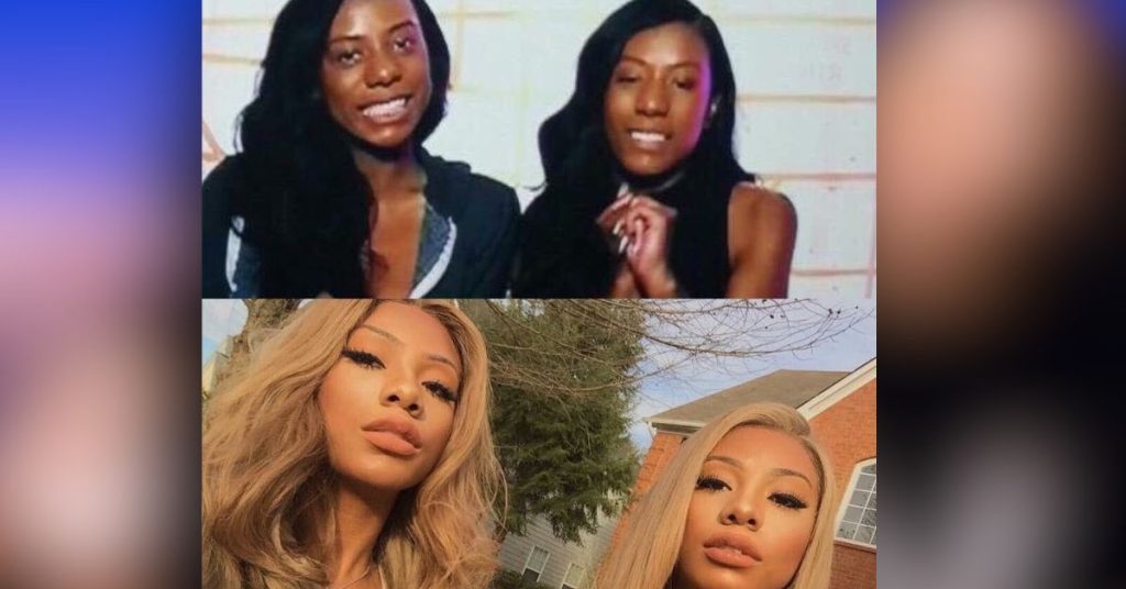 clermont twins before surgery 
