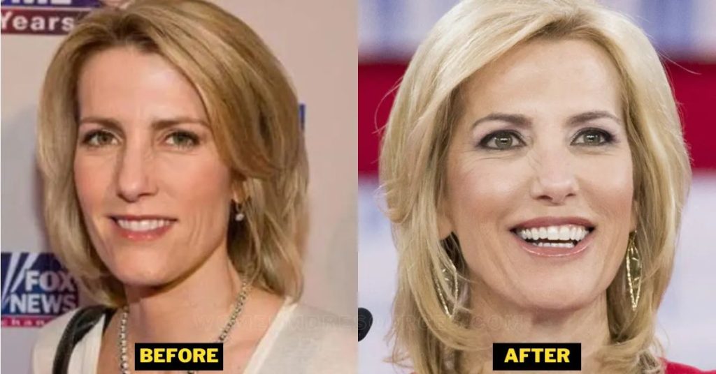 Laura Ingraham Plastic Surgery Speculation Transformation Photos