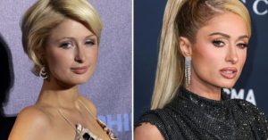 paris hilton plastic surgery 1