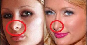 paris hilton plastic surgery