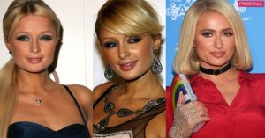 paris hilton plastic surgery