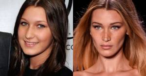 bella hadid before surgery