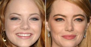 emma stone plastic surgery