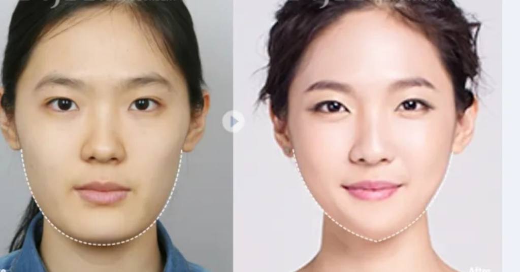 kpop plastic surgery trend