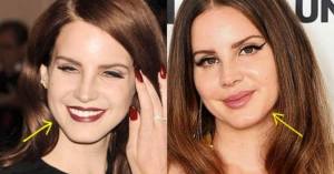 lana del rey plastic surgery