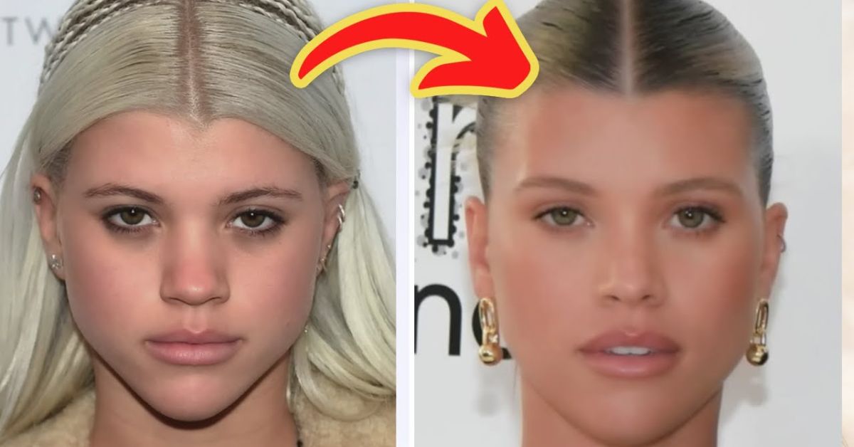 sofia richie plastic surgery