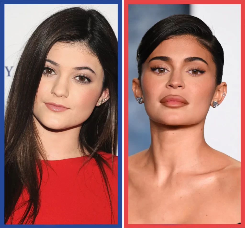 Cosmetic Procedures on Kylie Jenner’s Career and Life